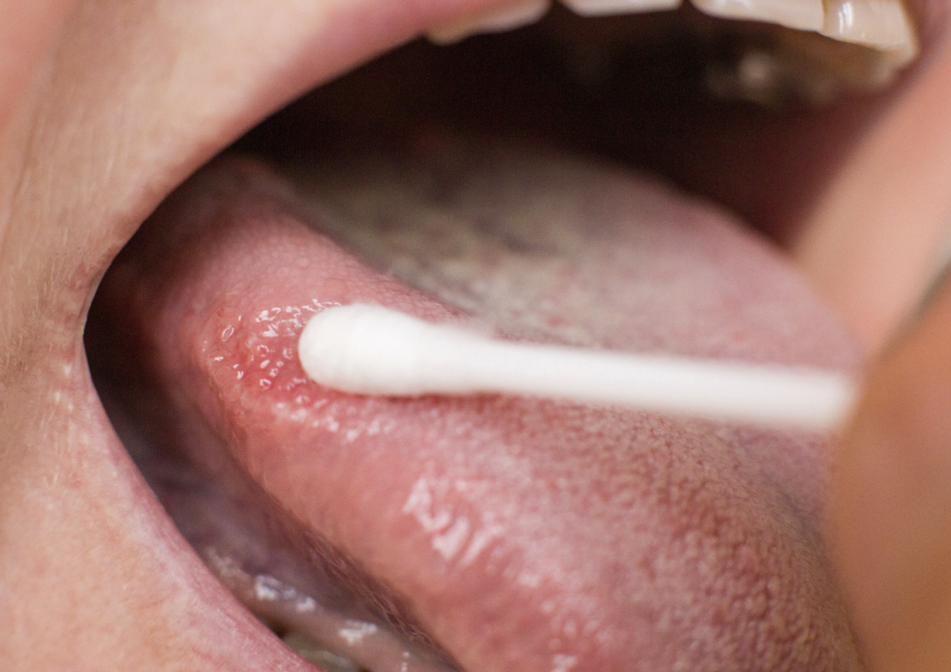 Leukoplakia